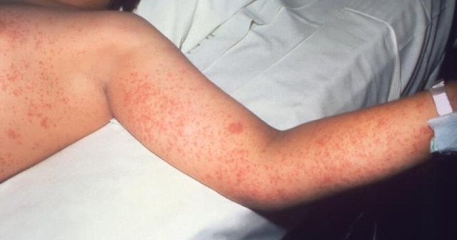 Measles rash on a child's arm